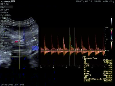 Blog 2. Estudio con Ultrasonido Vinno 5 con transductor microconvexo G4-9M usando Doppler color para visualizar Vena cava- aorta y porta y Doppler pulsado con mediciones automáticas